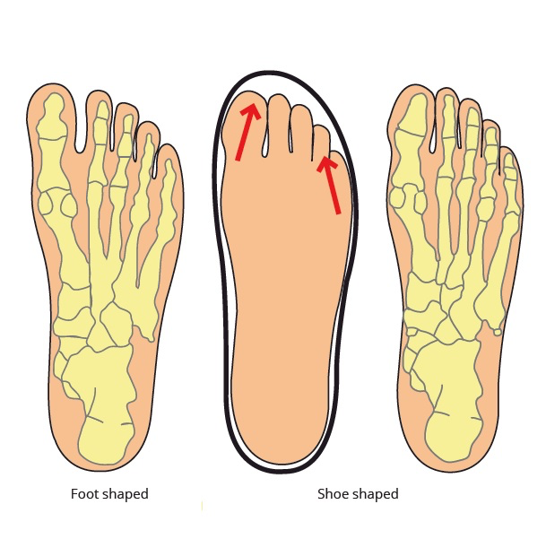 Foot Dysfunction THE SCIENCE OF FOOT DYSFUNCTION AND CURE – Functional Footwear